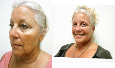 Facelift before and after photo