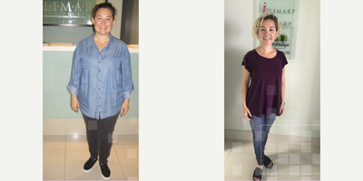 Gastric Sleeve Surgery before and after photo