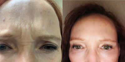 Xeomin before and after photo