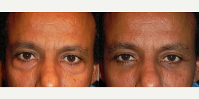Dermal Fillers before and after photo
