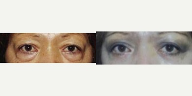 Eyelid Surgery before and after photo