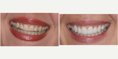 Porcelain Veneers before and after photo