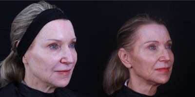 Restylane before and after photo