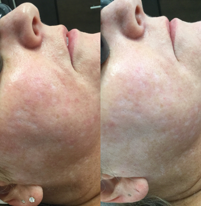 Skin Rejuvenation before and after photo