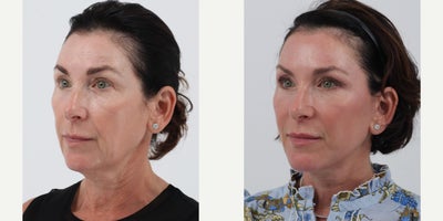 Facelift before and after photo