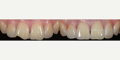 Dental Bonding before and after photo