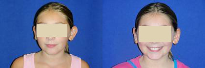 Ear Surgery before and after photo