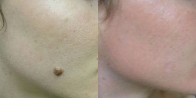 Mole Removal before and after photo