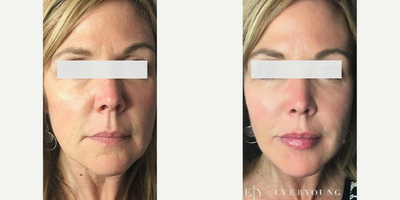 Dermal Fillers before and after photo