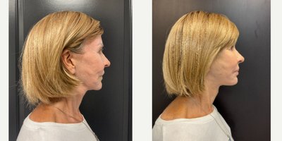 Mini Facelift before and after photo