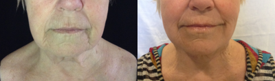 Renuvion before and after photo