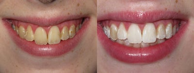 Teeth Whitening before and after photo