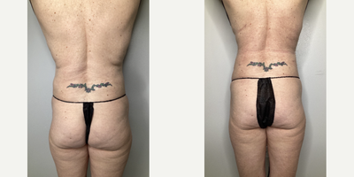 Vaser Liposuction before and after photo
