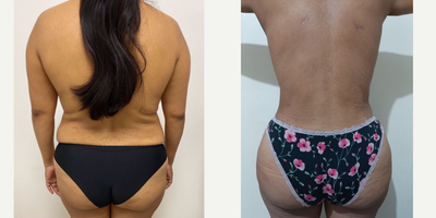 Brazilian Butt Lift before and after photo