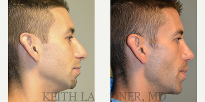 Chin Implant before and after photo