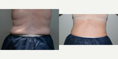 CoolSculpting before and after photo