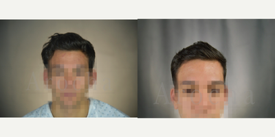 PRP for Hair Loss before and after photo