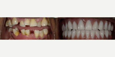 All-on-4 Dental Implants before and after photo