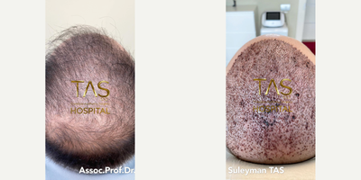 FUE Hair Transplant before and after photo