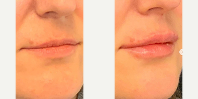 Juvederm before and after photo
