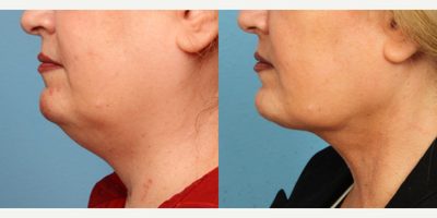 Liposuction before and after photo