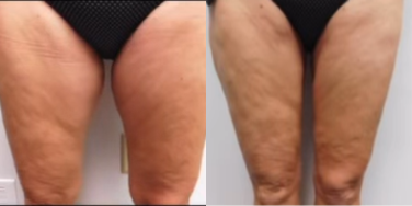 Liposuction before and after photo