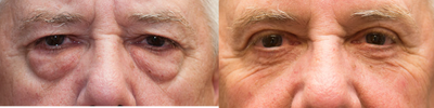 Eyelid Surgery before and after photo