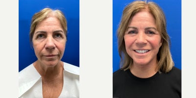 Facelift before and after photo