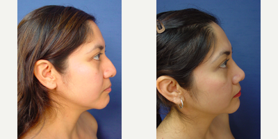 Rhinoplasty before and after photo