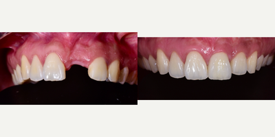 Dental Implants before and after photo