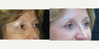 Eyelid Surgery before and after photo
