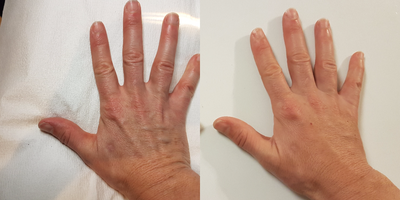 Radiesse before and after photo