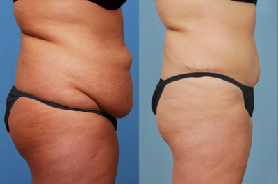 Tummy Tuck before and after photo