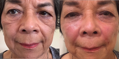 Voluma before and after photo