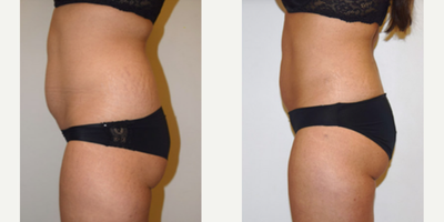 BodyTite before and after photo