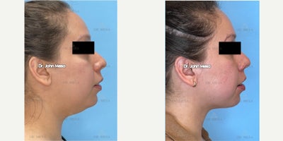 Chin Liposuction before and after photo