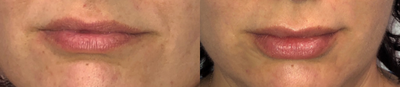 Lip Fillers before and after photo
