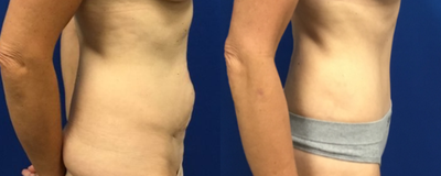 Tummy Tuck before and after photo