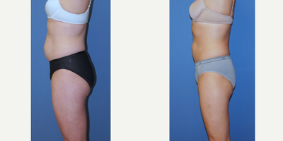 CoolSculpting before and after photo