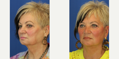 Facelift before and after photo