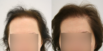 Hair Transplant before and after photo