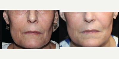 before and after image