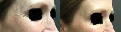Botox before and after photo