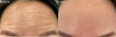 Botox before and after photo