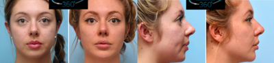 Cheek Fillers before and after photo