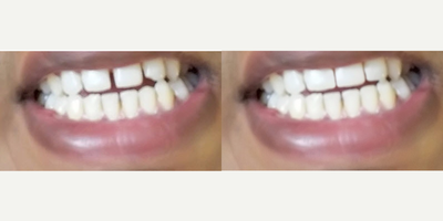 Dental Bonding before and after photo