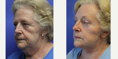 Facelift before and after photo