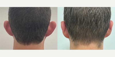 Ear Surgery before and after photo