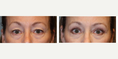 Eyelid Surgery before and after photo