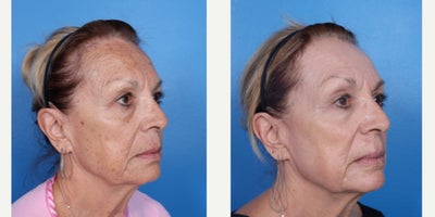 Laser Resurfacing before and after photo